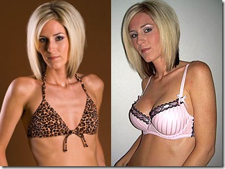 Healthy Life: Breast Implants